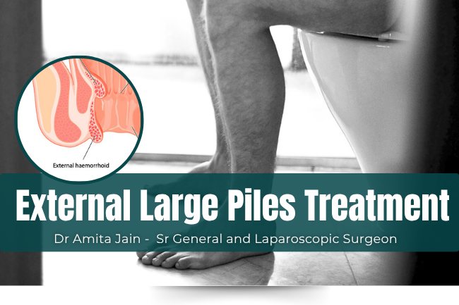 Large Piles or external Hemorrhoids treatment by Dr Amita Jain
